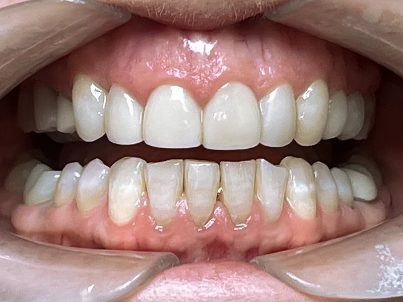 After ortho restoration treatment