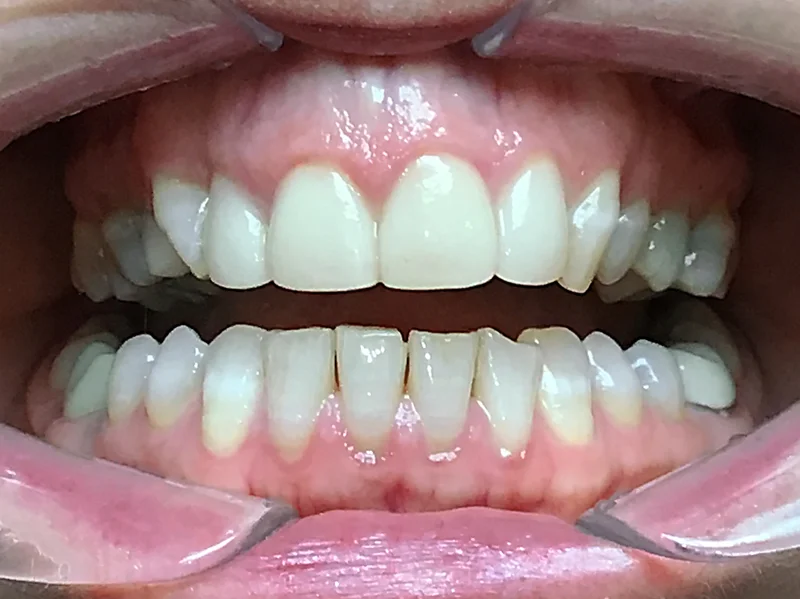 Before ortho restoration treatment