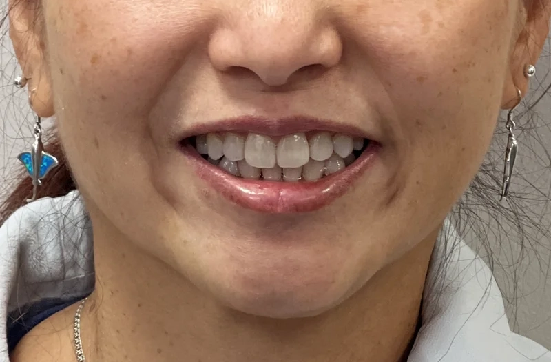 After ortho restoration treatment