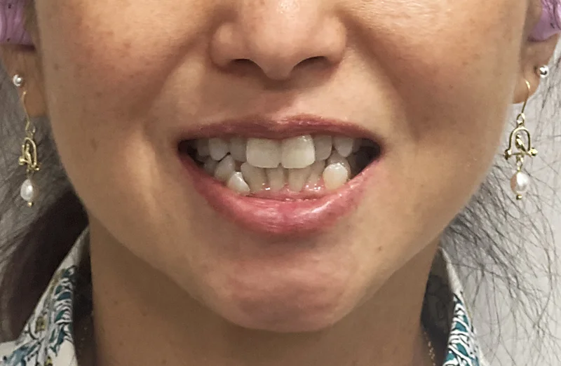 Before ortho restoration treatment